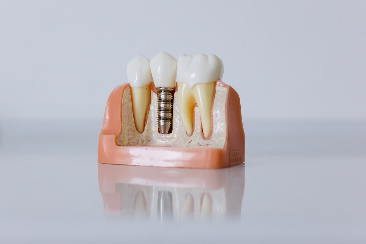 charakterystyka implantow stomatologicznych